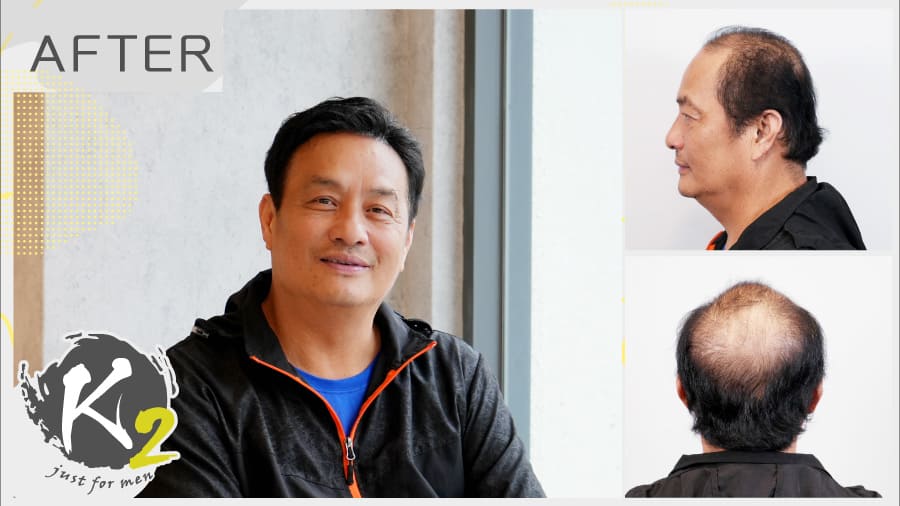 即刻救髮的那一天，爸爸找回的不只是頭髮