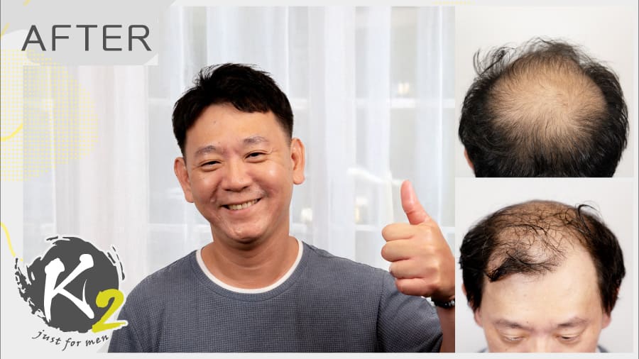 掉髮十年，他用髮片找回自信